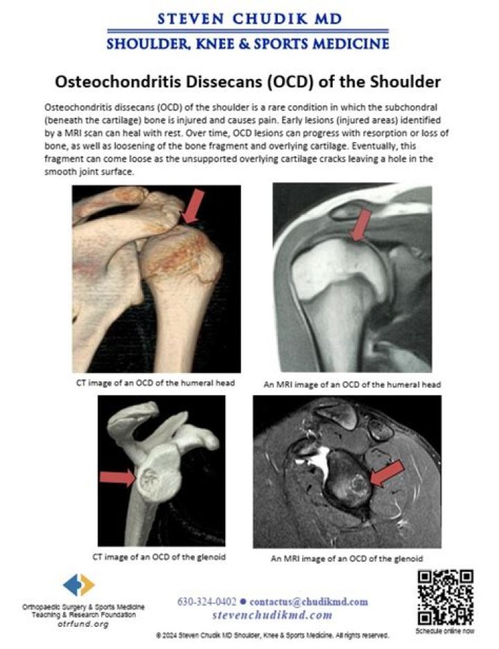 What are the symptoms of osteochondritis dissecans?
