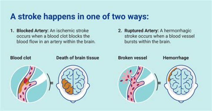 What are the types of hemorrhagic stroke?