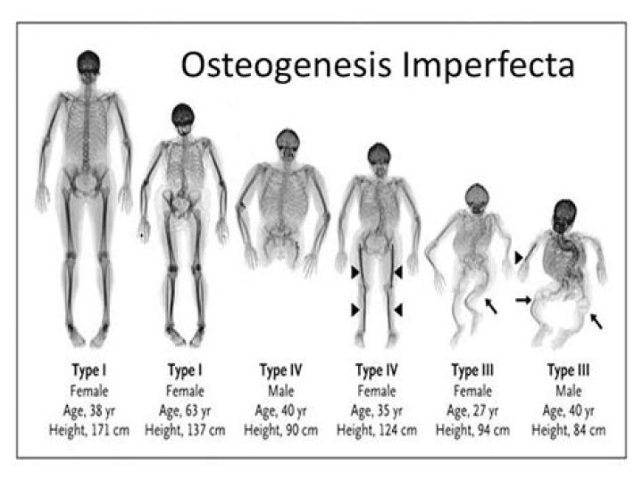 What are the types of osteogenesis imperfecta?