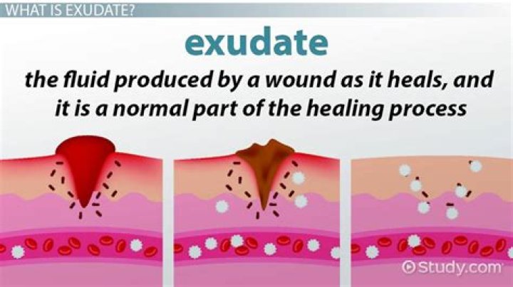 What are wound exudates?