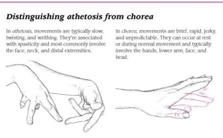 What are writhing movements?
