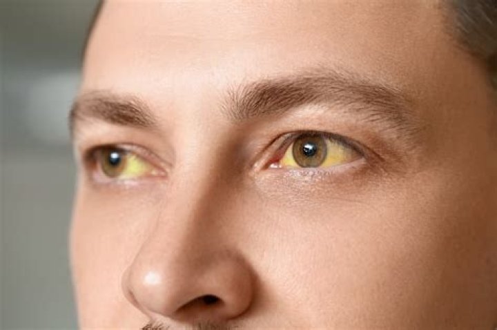 What are you lacking if your eyes are yellow?