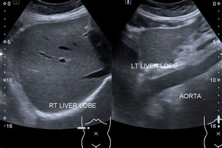 What can be found in a liver ultrasound?