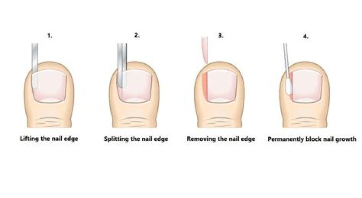 What can be mistaken for an ingrown toenail?