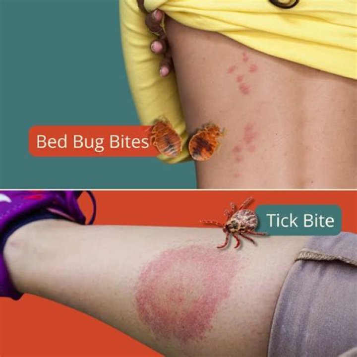 What can be mistaken for bug bites?