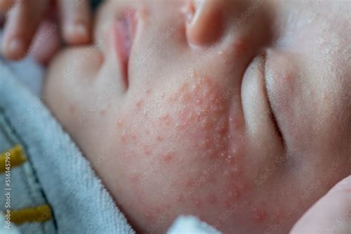 What can I put on my toddlers neck rash?