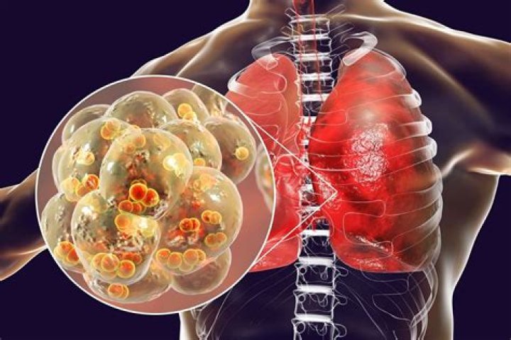 What caused Brittany Murphys pneumonia?