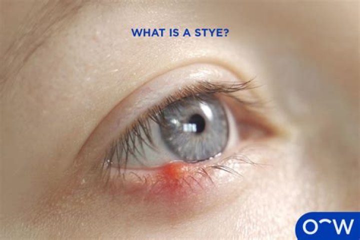 What causes a white stye?