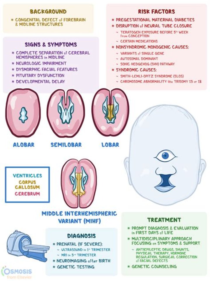 What causes Alobar holoprosencephaly?