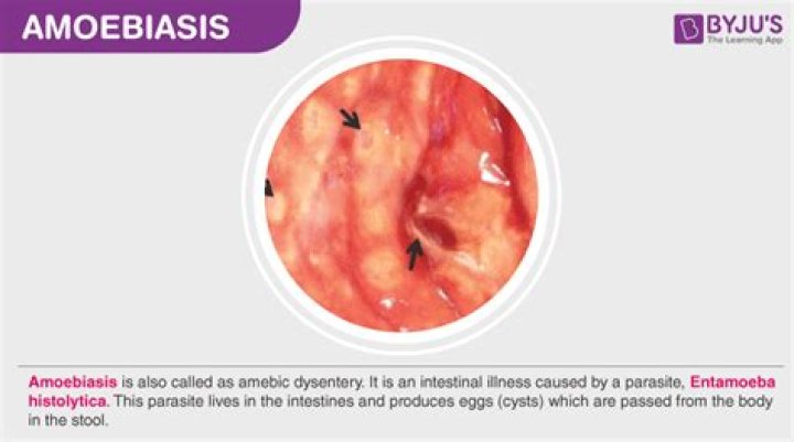 What causes amoeba infection?
