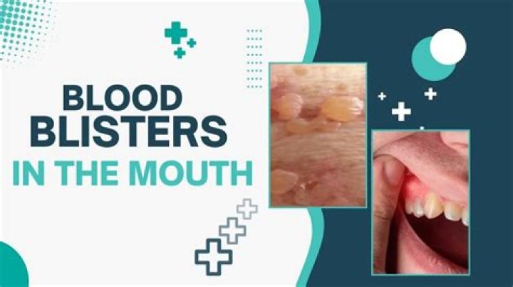 What causes blisters in mouth after eating?
