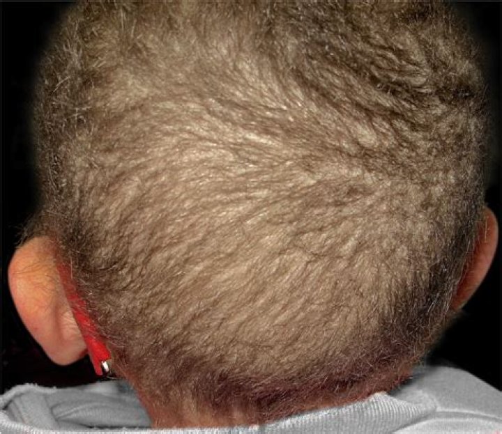 What causes brittle hair syndrome?