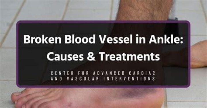 What causes broken blood vessels in lower legs?