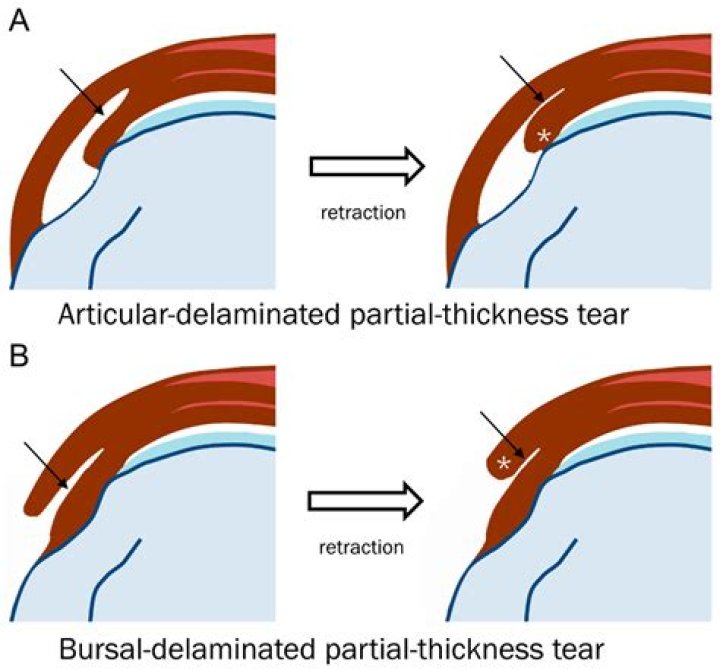 What causes bursal thickening?
