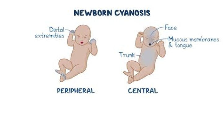 What causes central cyanosis in newborns?