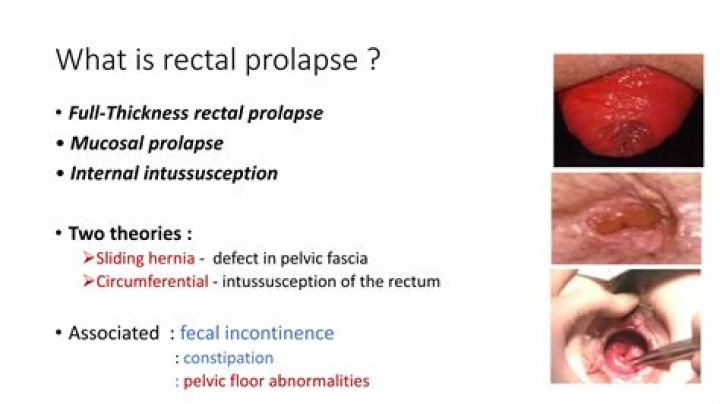 What causes complete rectal prolapse?