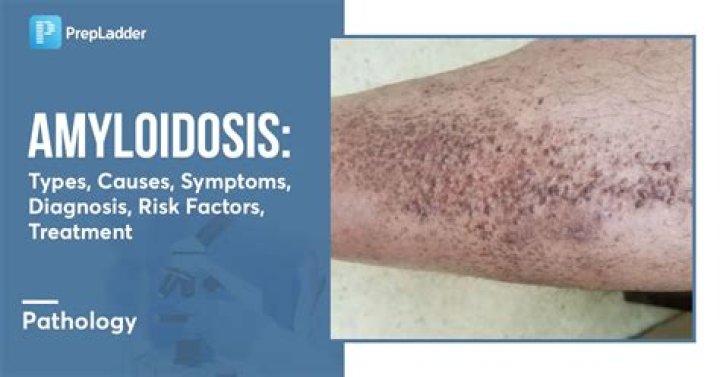 What causes cutaneous amyloidosis?