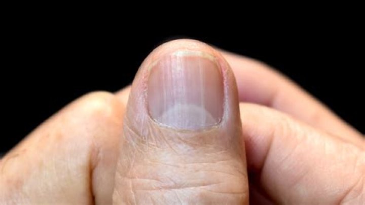 What causes fingernail abnormalities?