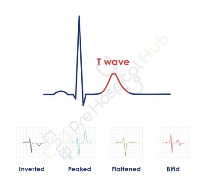 What causes flattening of T-wave?