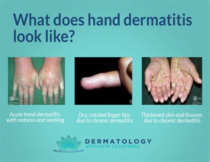 What causes hand eczema?