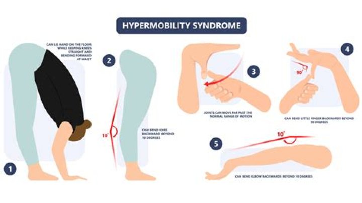 What causes hypermobility syndrome?