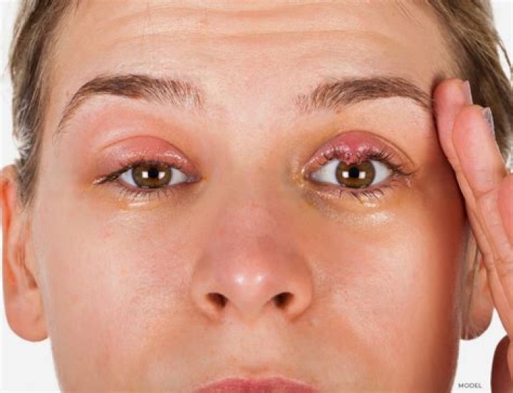 What causes lesions on the eyelid?