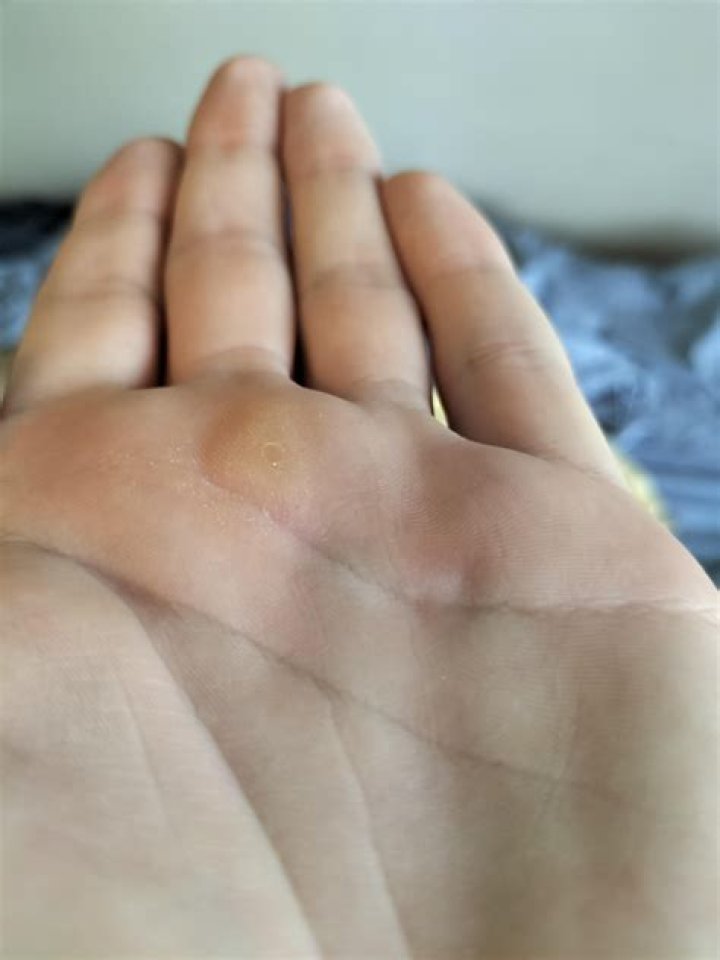 What causes lumps on the palms of your hands?