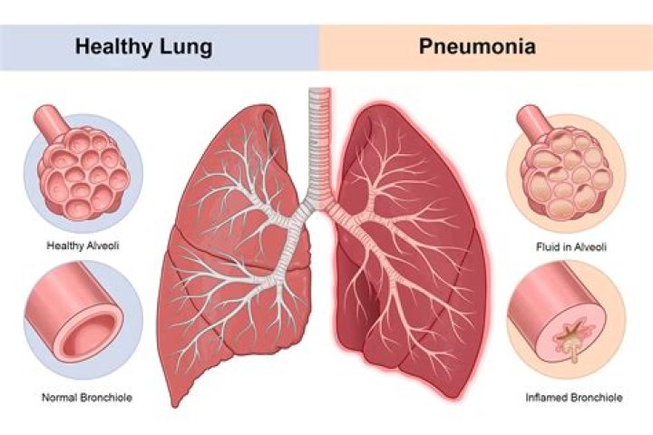 What causes middle lobe pneumonia?