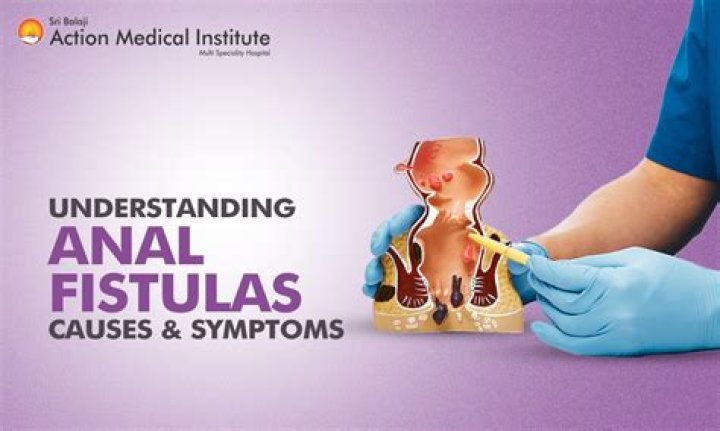 What causes perianal fistula?