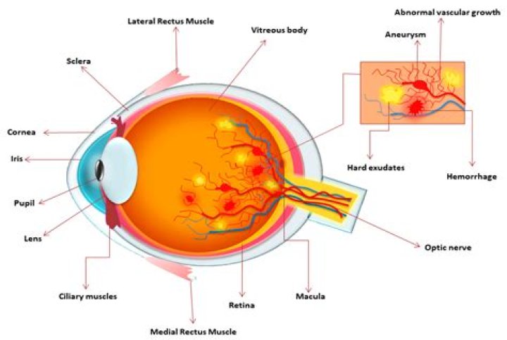 What causes small hemorrhages in the eye?