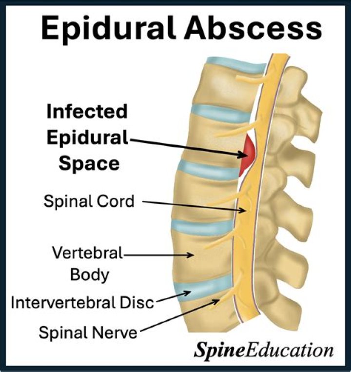 What causes thoracic epidural abscess?