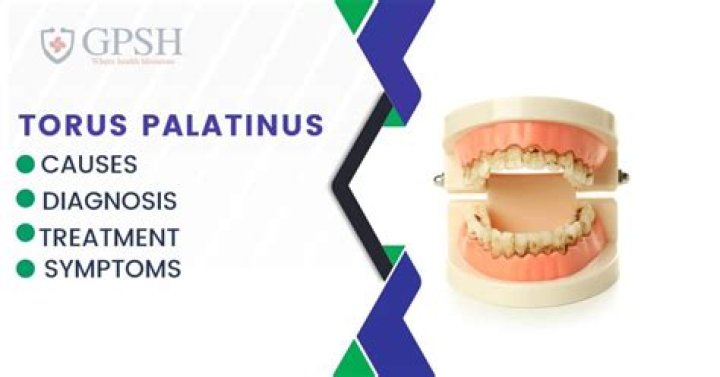 What causes Tori palatinus?