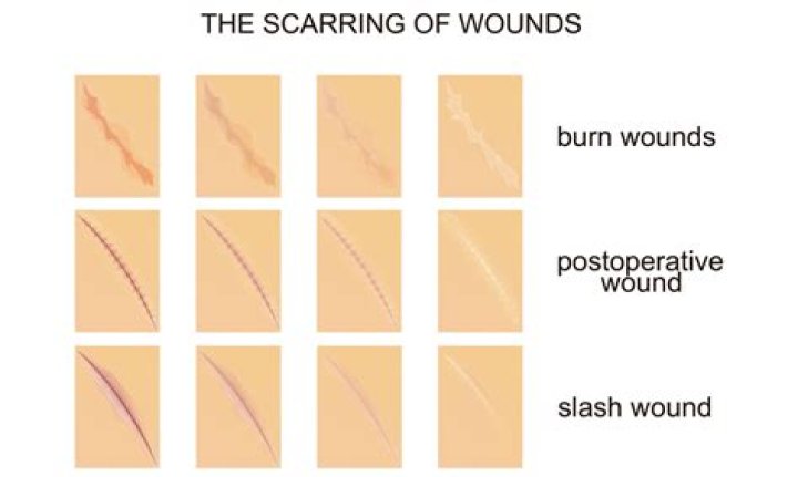 What color are healed scars?
