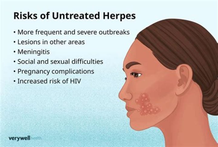 What comes out when herpes Pops?