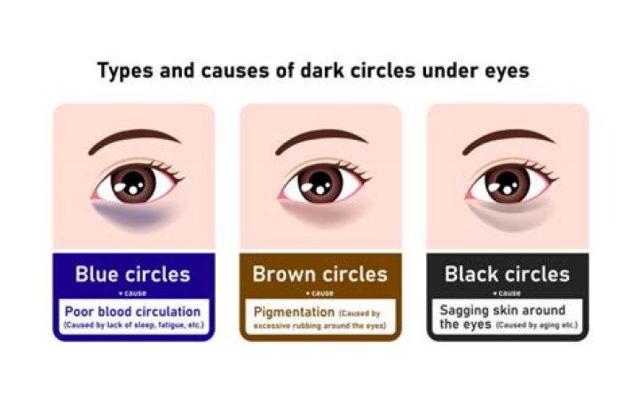 What deficiency causes under eye circles?
