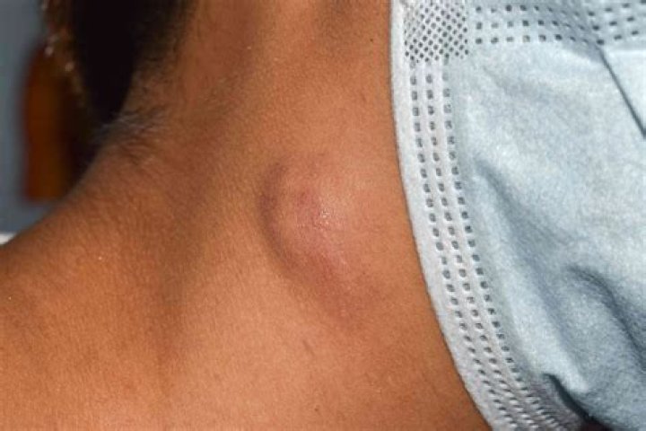 What disease causes lumps under the skin?