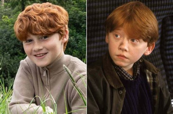 What disease does Rupert Grint have?