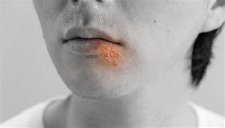 What do herpes boils look like?