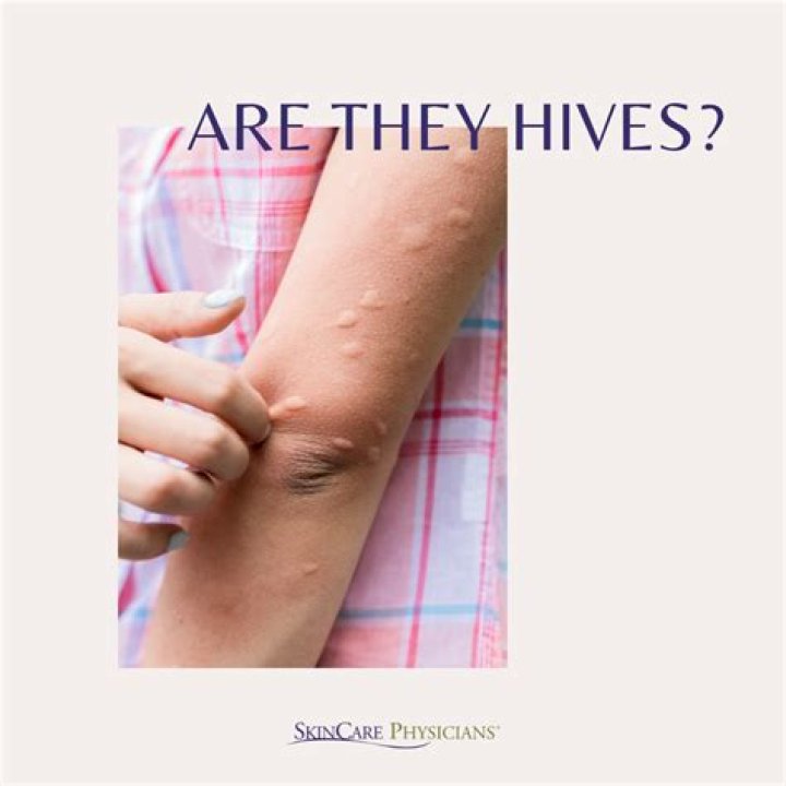 What do stress induced hives look like?