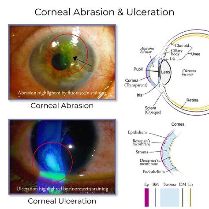 What does a corneal abrasion look like with fluorescein?