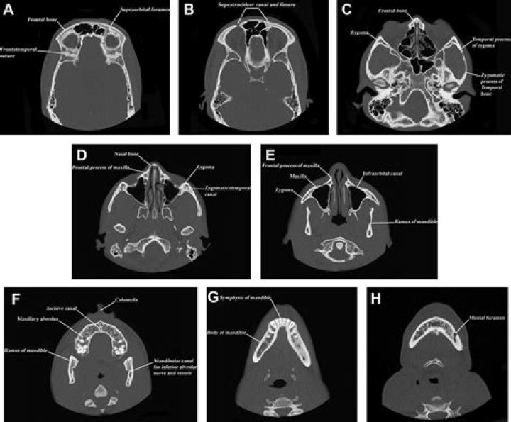 What does a cranial CT show?