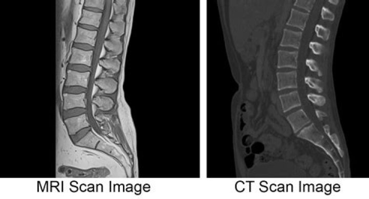 What does a CT scan of the lumbar spine show?