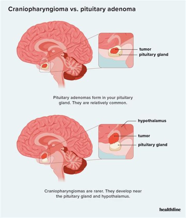 What does a cyst on your pituitary gland mean?