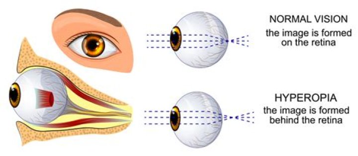 What does a hyperopic eye need?