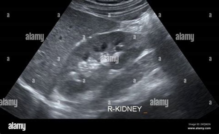 What does a kidney ultrasound detect?