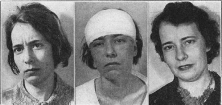 What does a lobotomy do to a person?