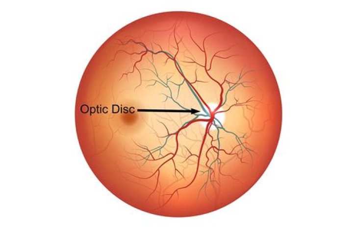 What does a normal optic disc look like?