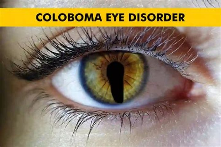 What does a person with coloboma see?