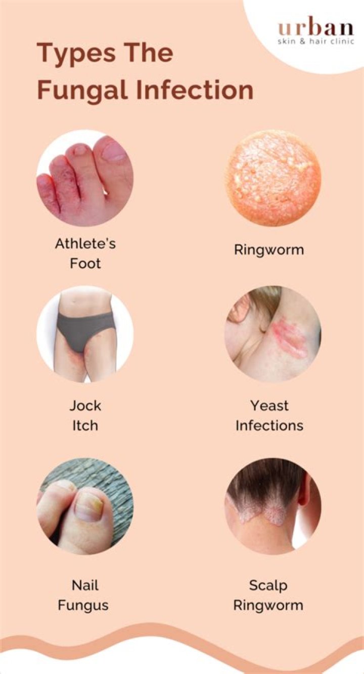 What does a skin fungal infection look like?
