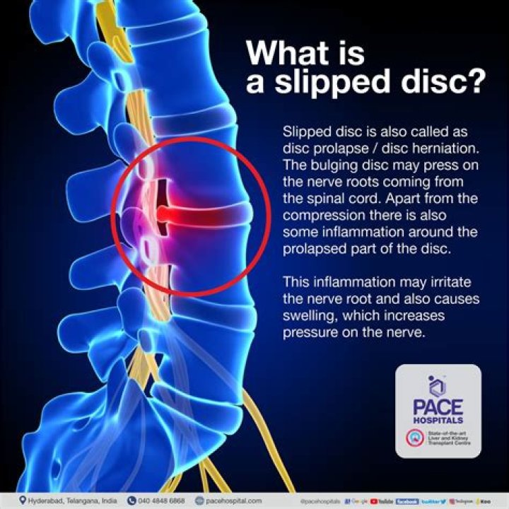 What does a slipped TMJ disc feel like?